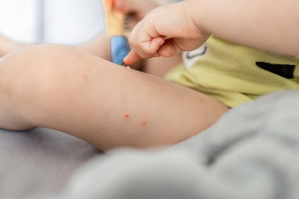 piqûre punaise de lit bébé